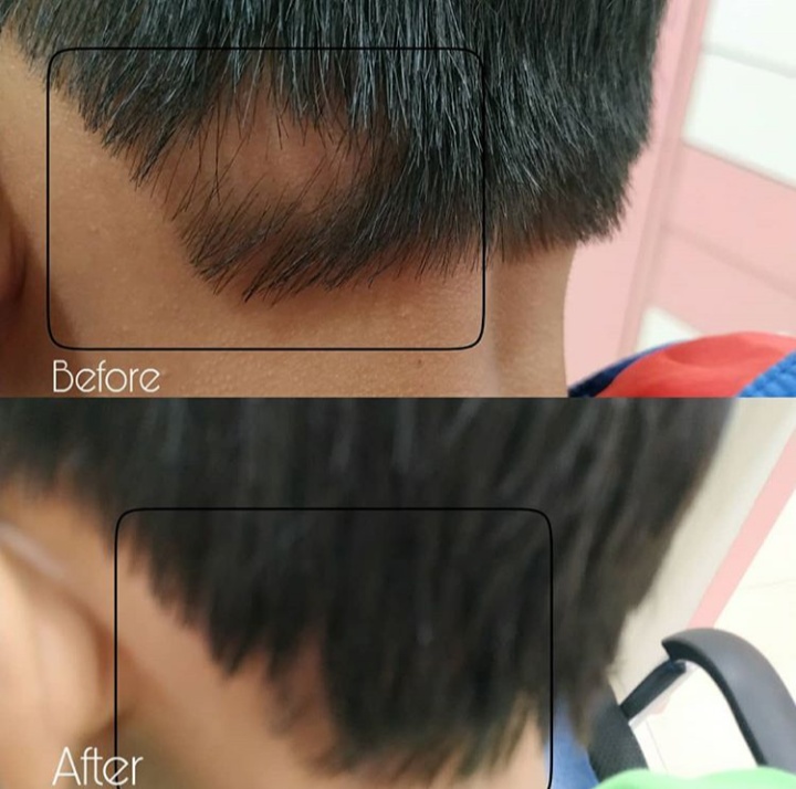 Alopecia Areata is a condition that causes hair to fall out in small patches.