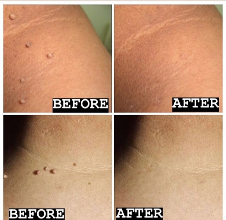 Wart is a small growth with a rough texture that can appear anywhere on the body.